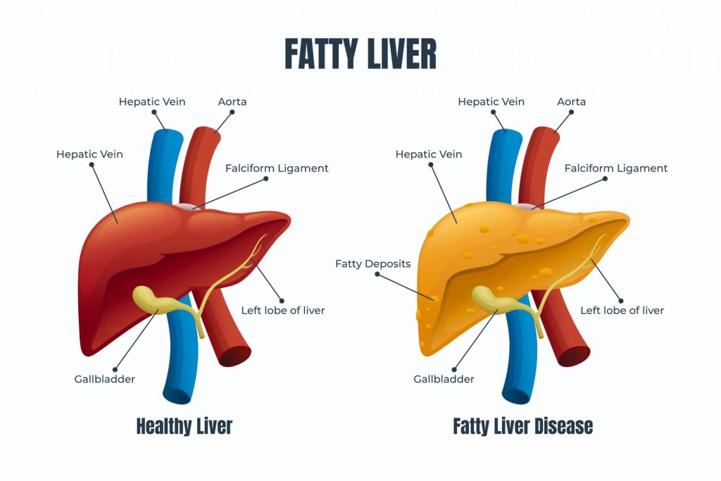 Fatty Liver disease illustration