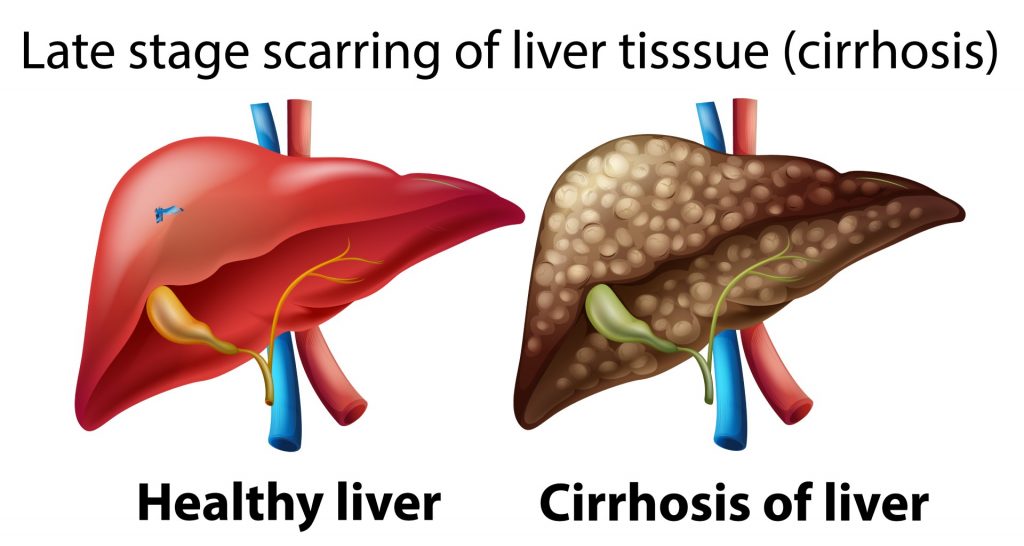 Stages of liver cirrhosis 