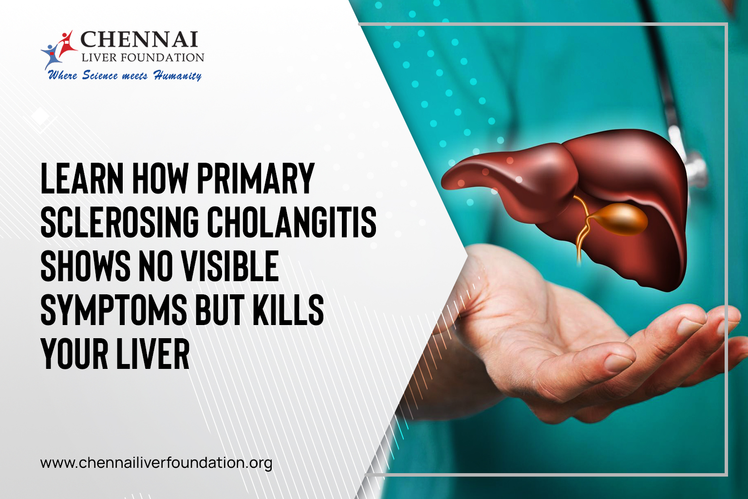 Learn How Primary Sclerosing Cholangitis Shows No Visible Symptoms But Kills Your Liver